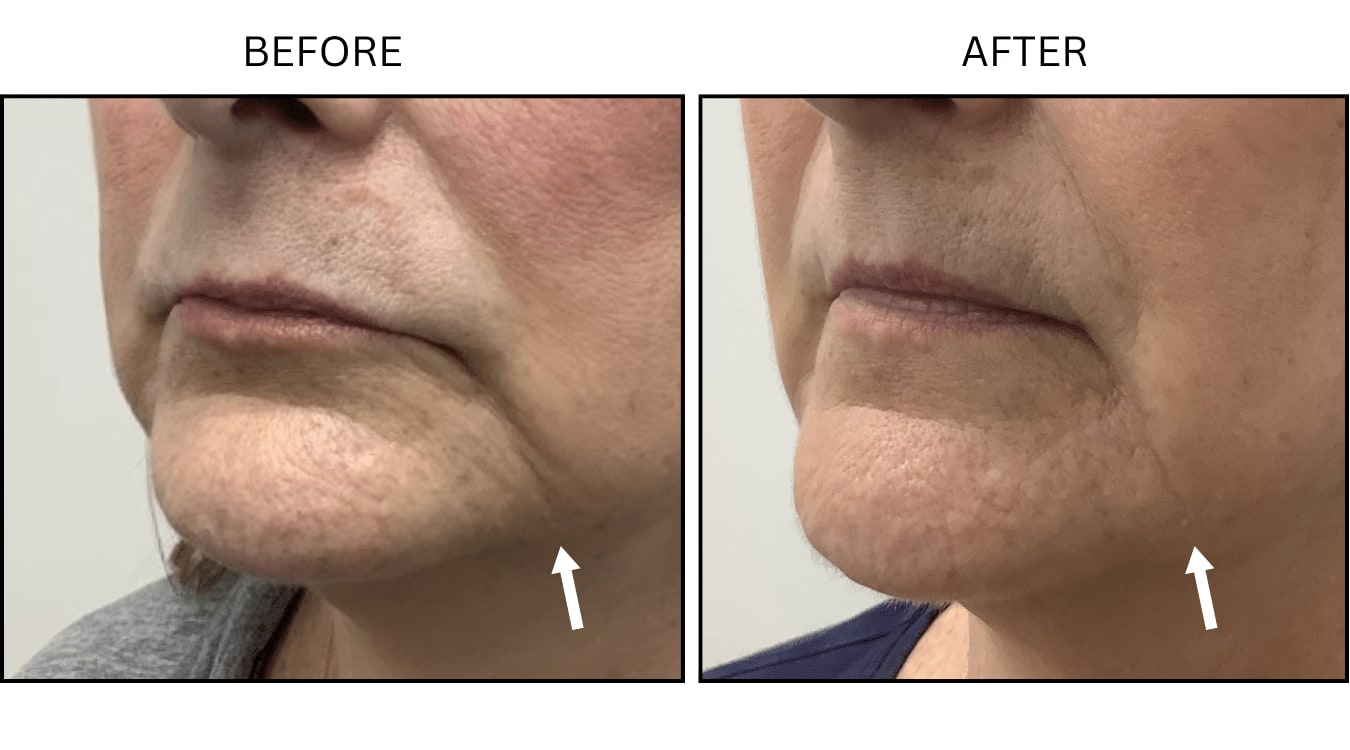 Marionette Lines (Fillers), before and after photograph 6