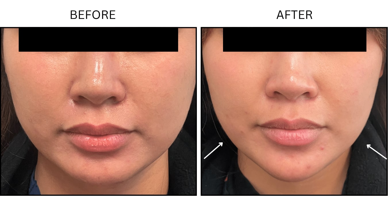 Masseter (Neurotoxin Relaxers), before and after photograph 1