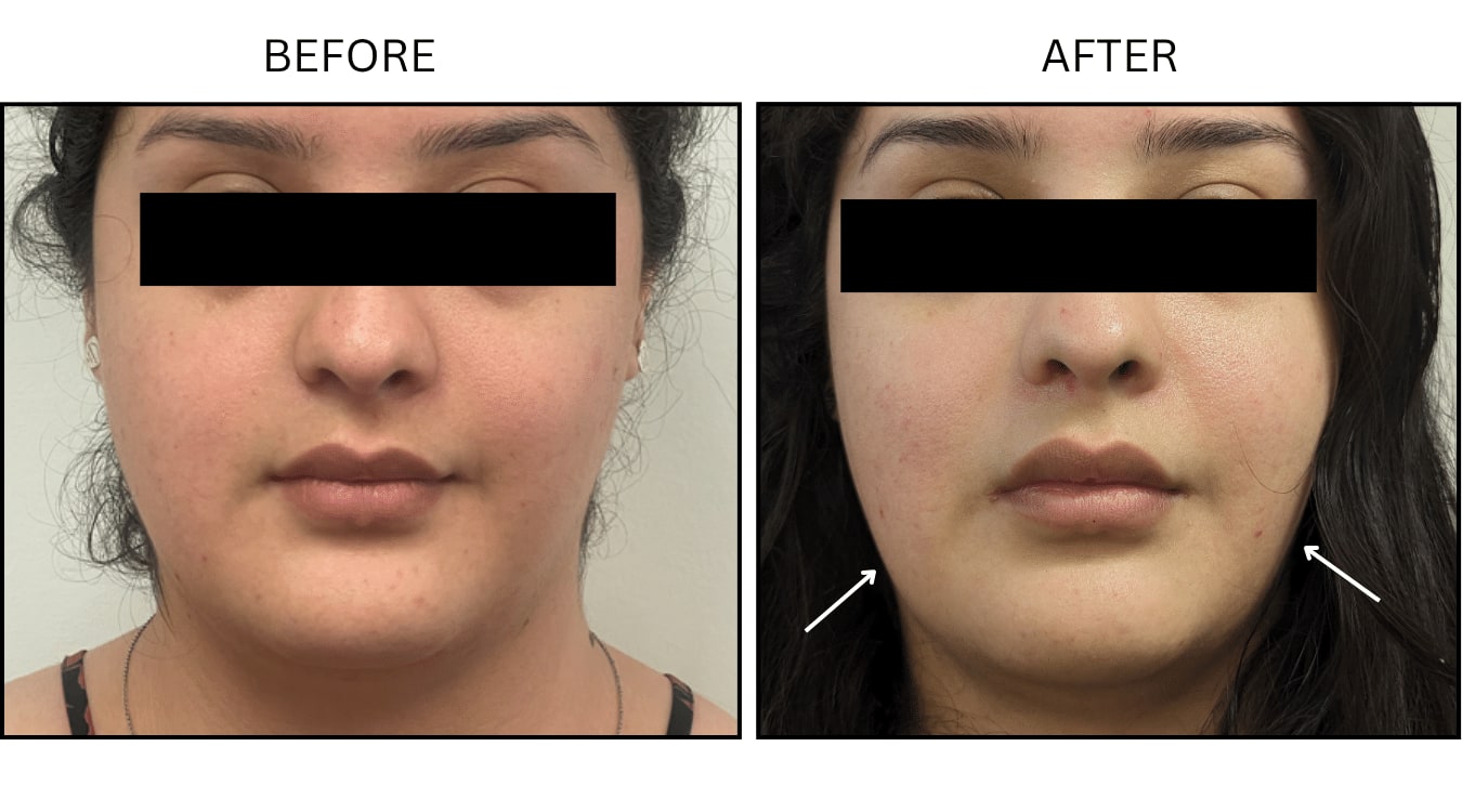 Masseter (Neurotoxin Relaxers), before and after photograph 2