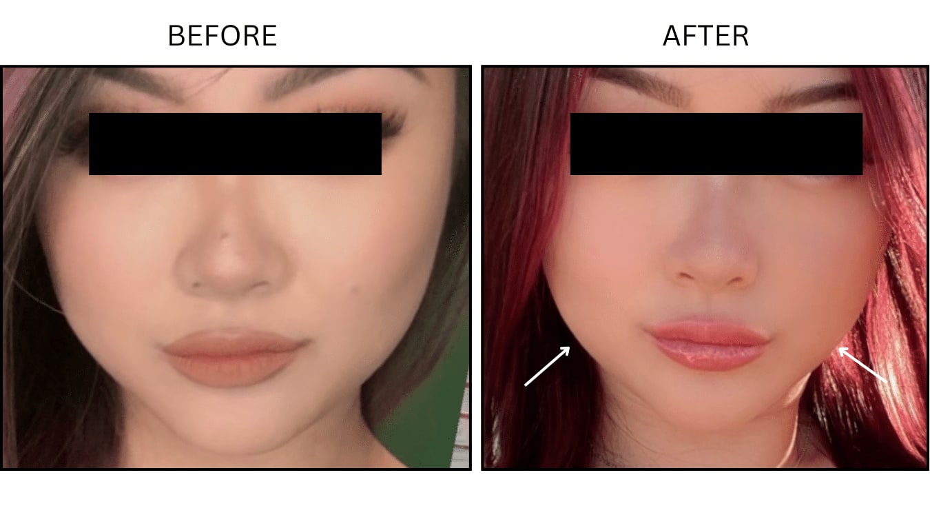 Masseter (Neurotoxin Relaxers), before and after photograph 3