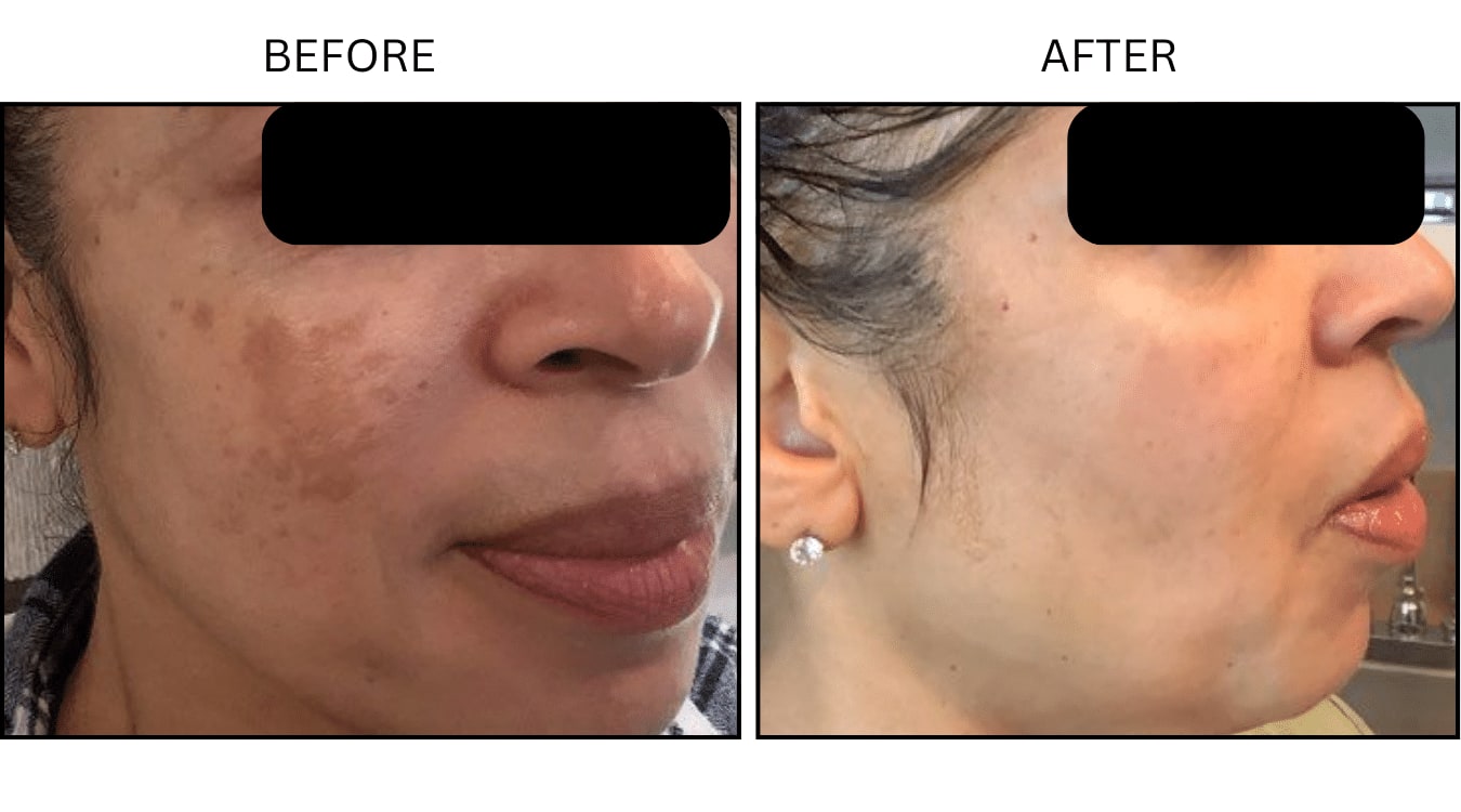 Melasma (Medical), before and after photograph 1