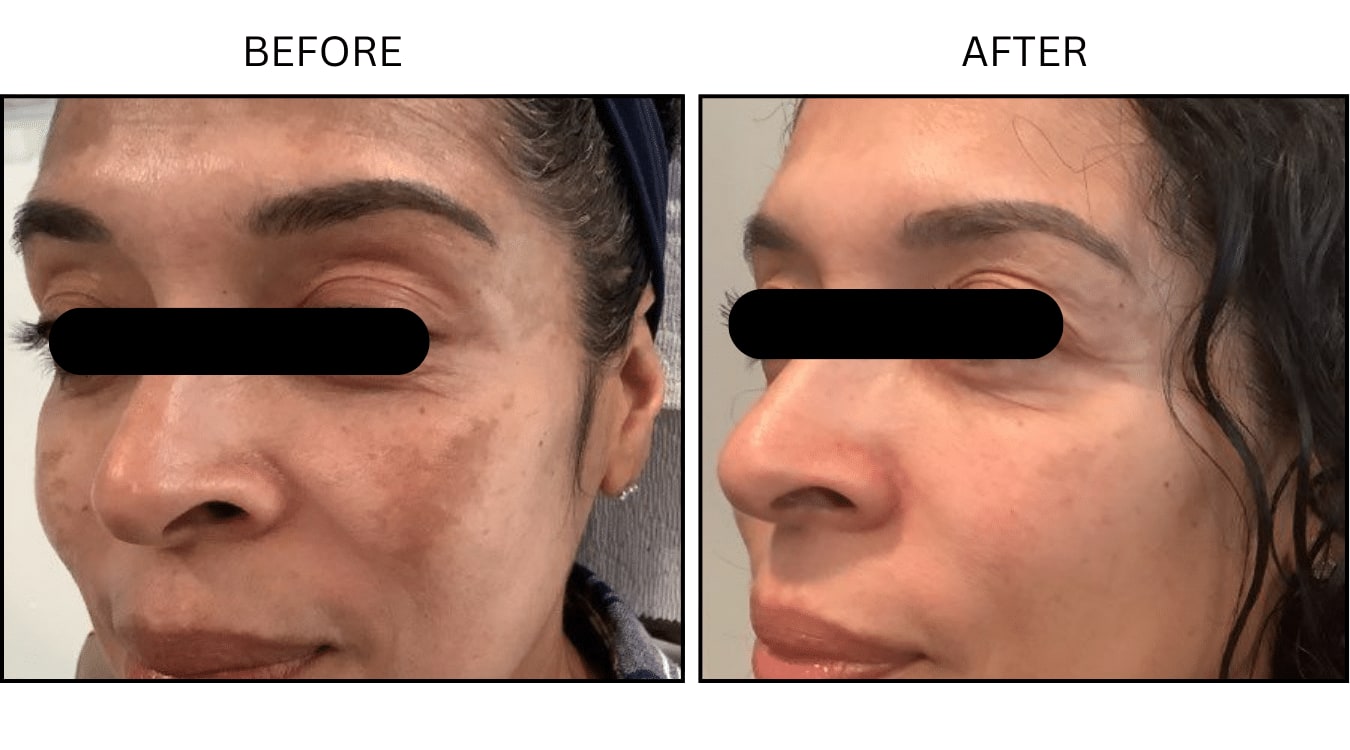 Melasma (Medical), before and after photograph 2