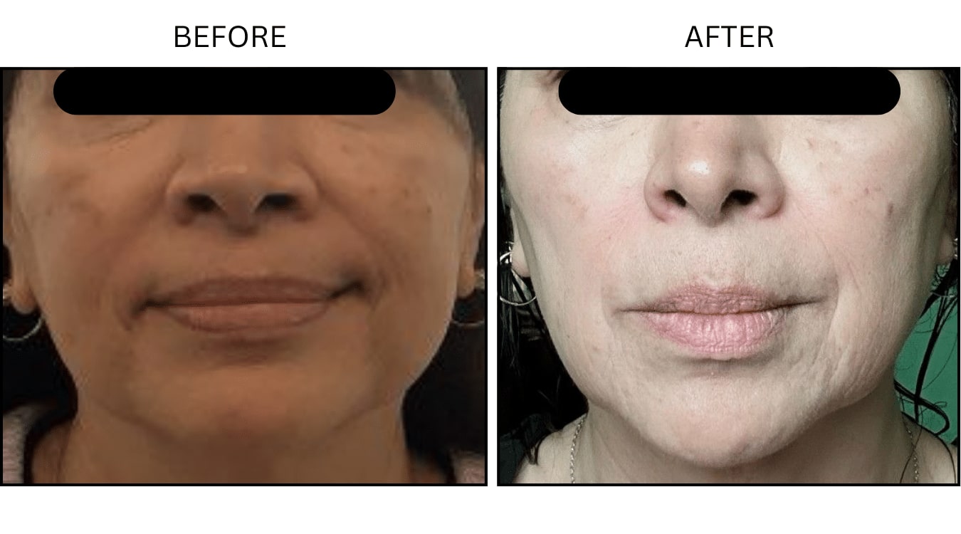 Melasma (Medical), before and after photograph 3