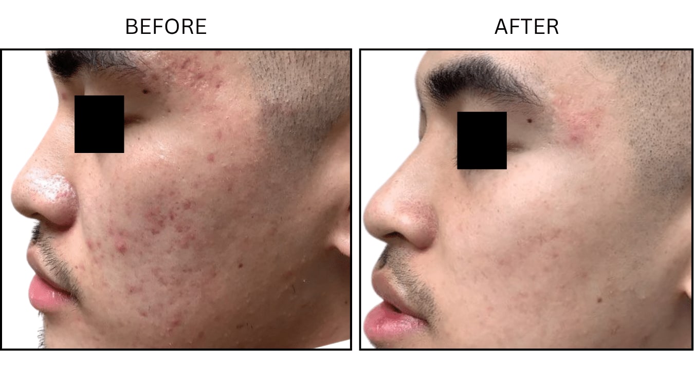 Micro-needling (Microneedling), before and after photograph 1