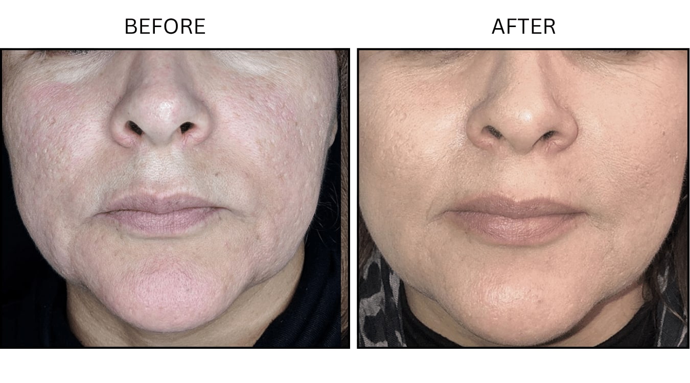 Micro-needling (Microneedling), before and after photograph 2
