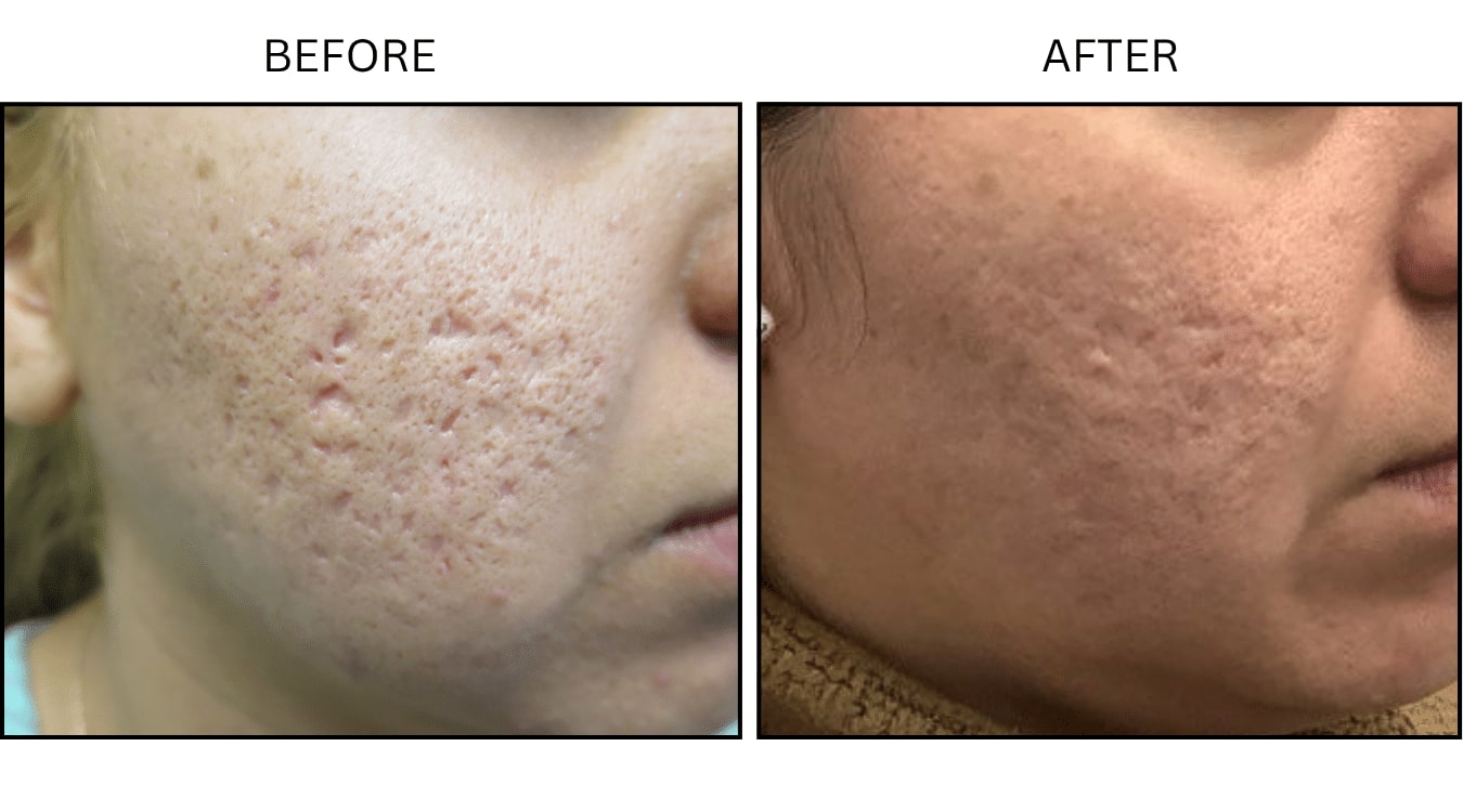 Micro-needling (Microneedling), before and after photograph 3