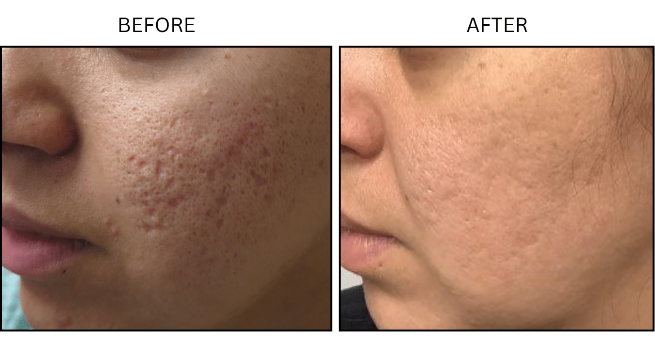 Micro-needling (Microneedling), before and after photograph 4