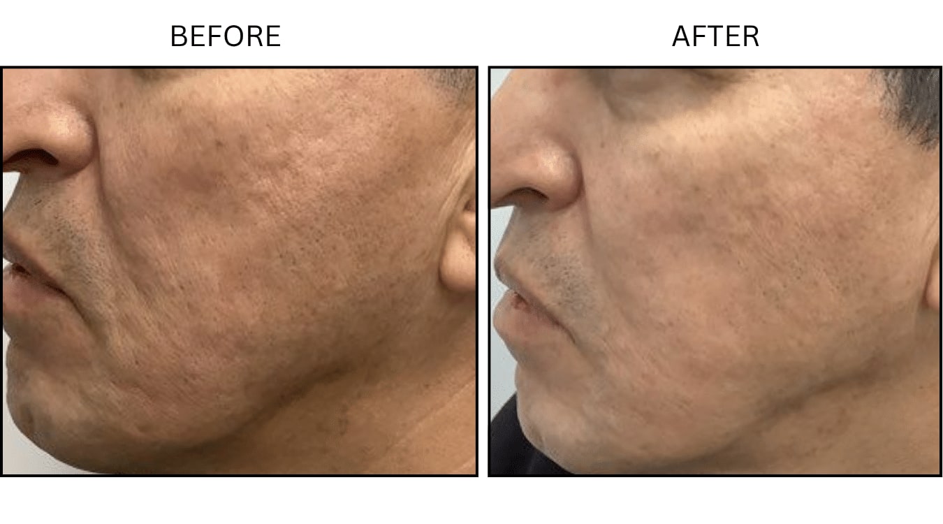 Micro-needling (Microneedling), before and after photograph 5