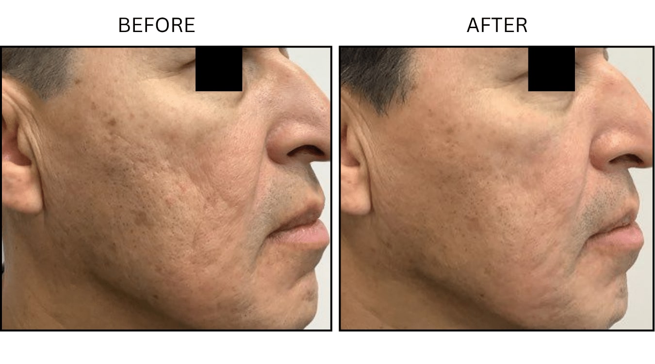 Micro-needling (Microneedling), before and after photograph 6