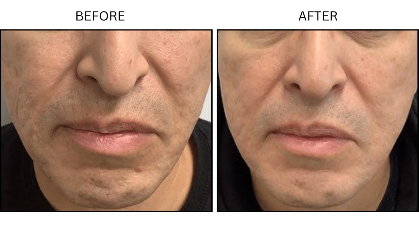Micro-needling (Microneedling), before and after photograph 7