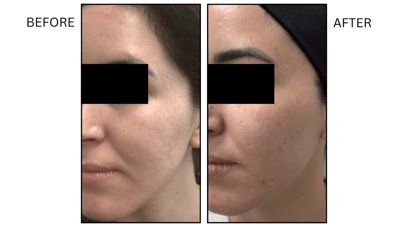 Micro-needling (Microneedling), before and after photograph 14