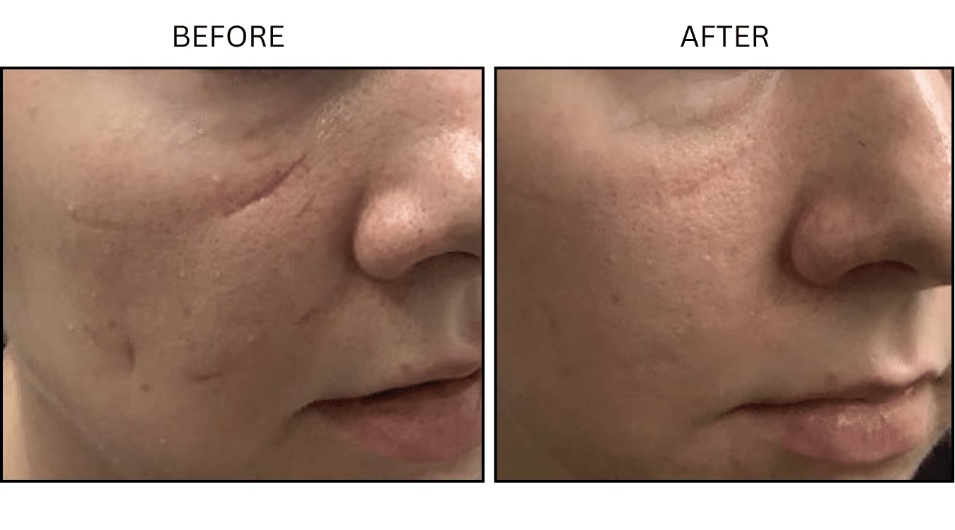 Micro-needling (Microneedling), before and after photograph 15