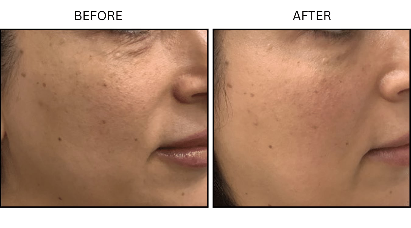 Micro-needling (Microneedling), before and after photograph 8