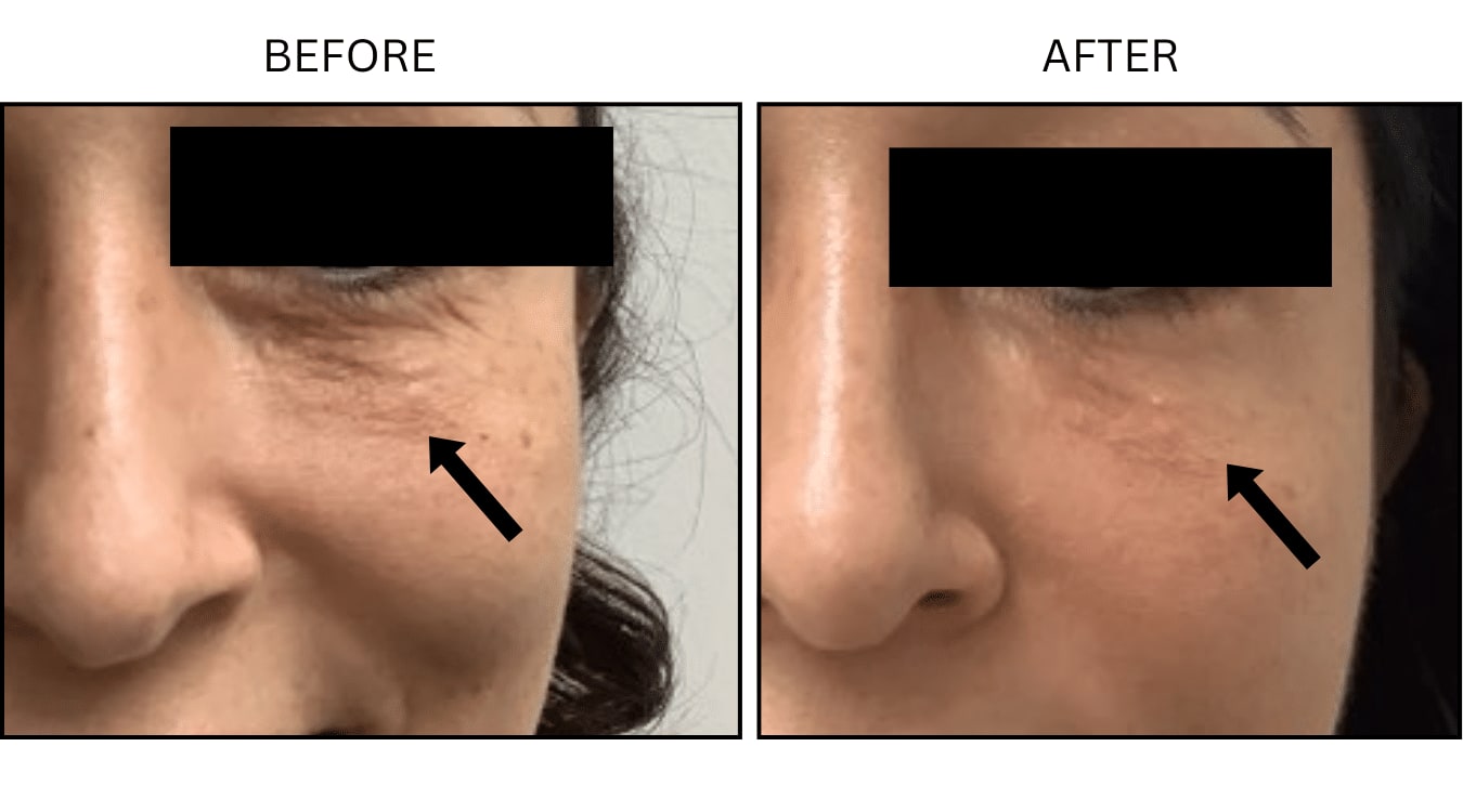 Micro-needling (Microneedling), before and after photograph 9