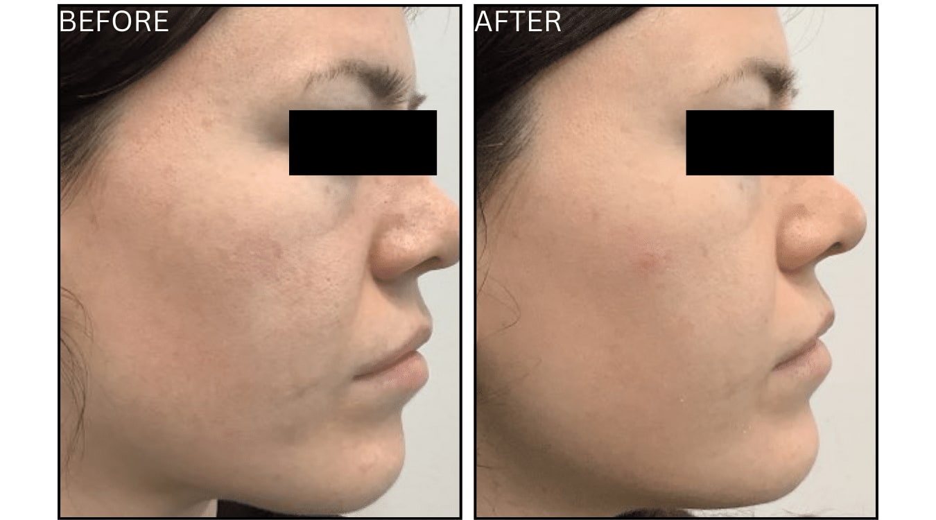 Micro-needling (Microneedling), before and after photograph 10