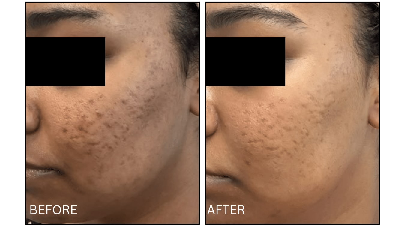 Micro-needling (Microneedling), before and after photograph 11