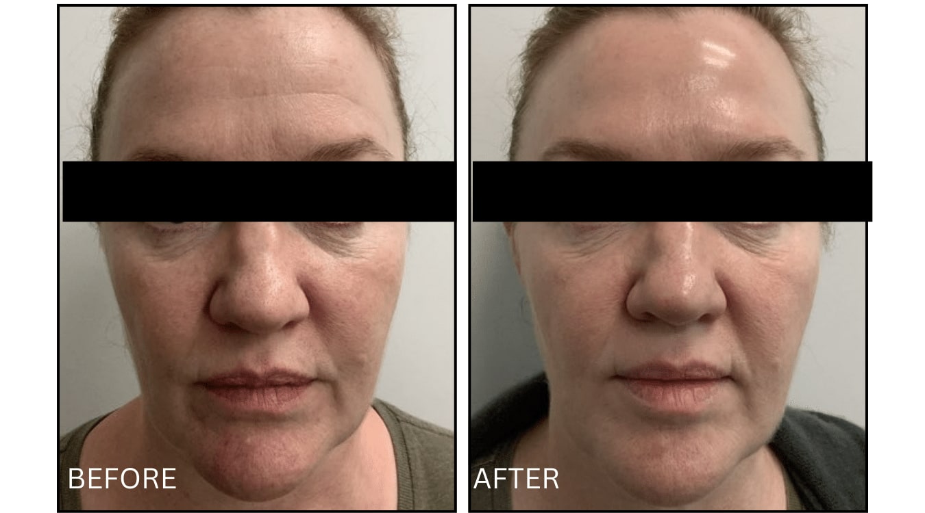 Micro-needling (Microneedling), before and after photograph 12