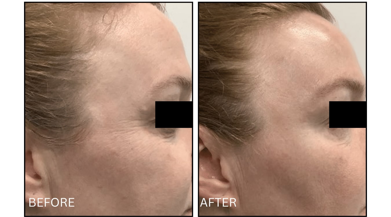 Micro-needling (Microneedling), before and after photograph 13