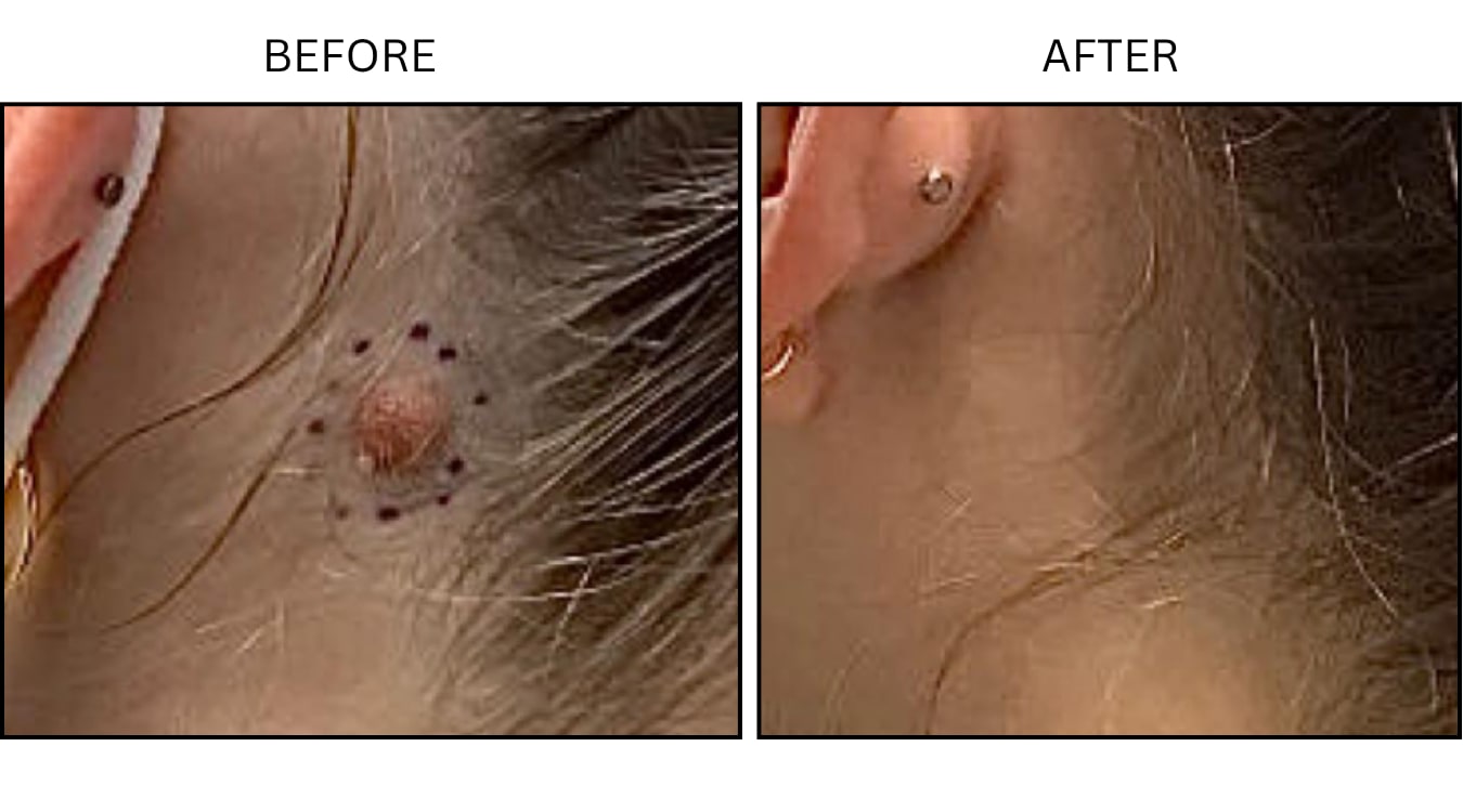 Mole Removal (Surgical (benign Destruction)), before and after photograph 2