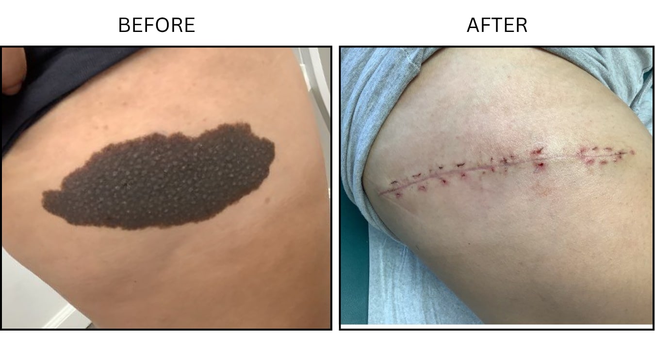 Mole Removal (Surgical (benign Destruction)), before and after photograph 3