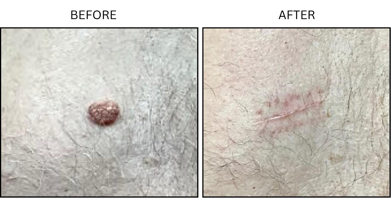Mole Removal (Surgical (benign Destruction)), before and after photograph 4