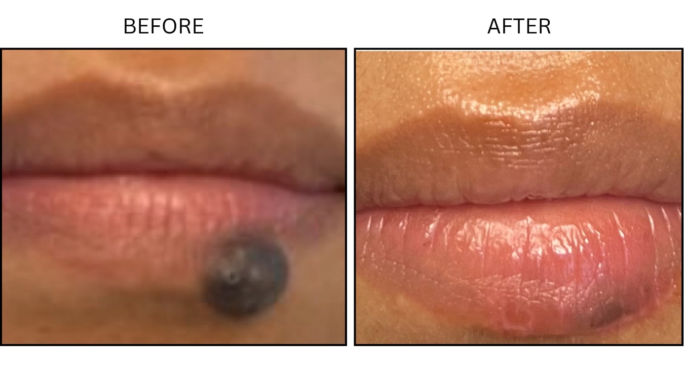 Mole Removal (Surgical (benign Destruction)), before and after photograph 5