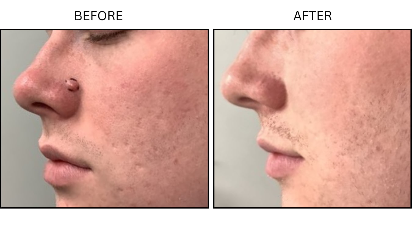 Mole Removal (Surgical (benign Destruction)), before and after photograph 6