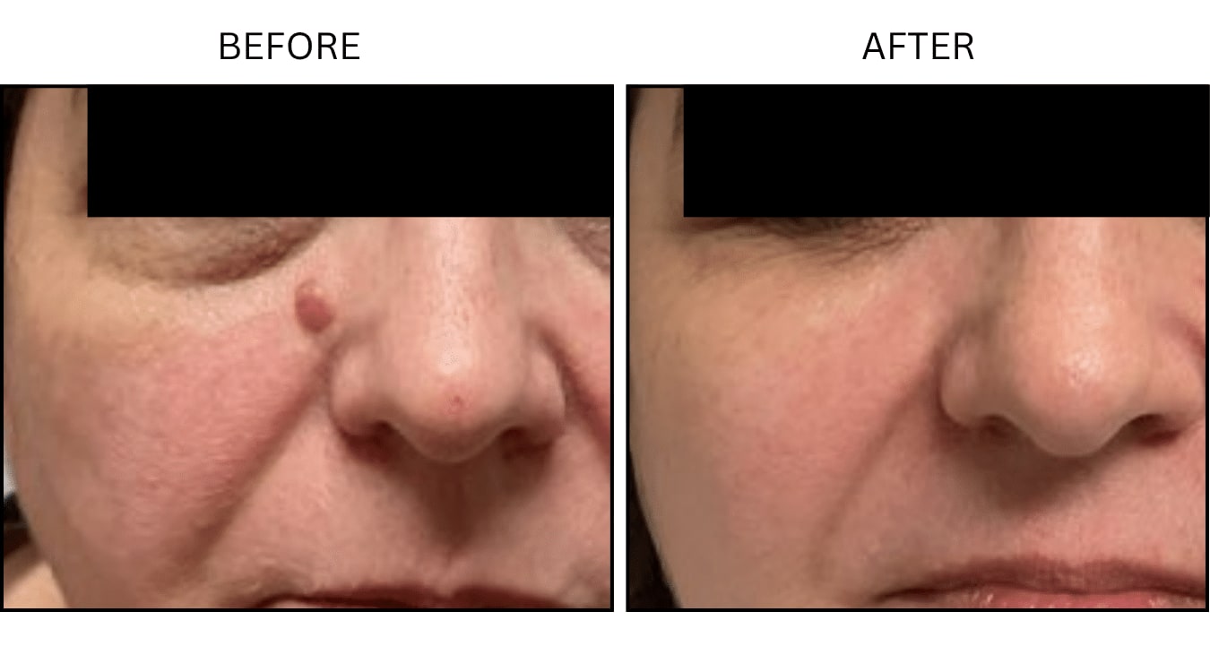 Mole Removal (Surgical (benign Destruction)), before and after photograph 1