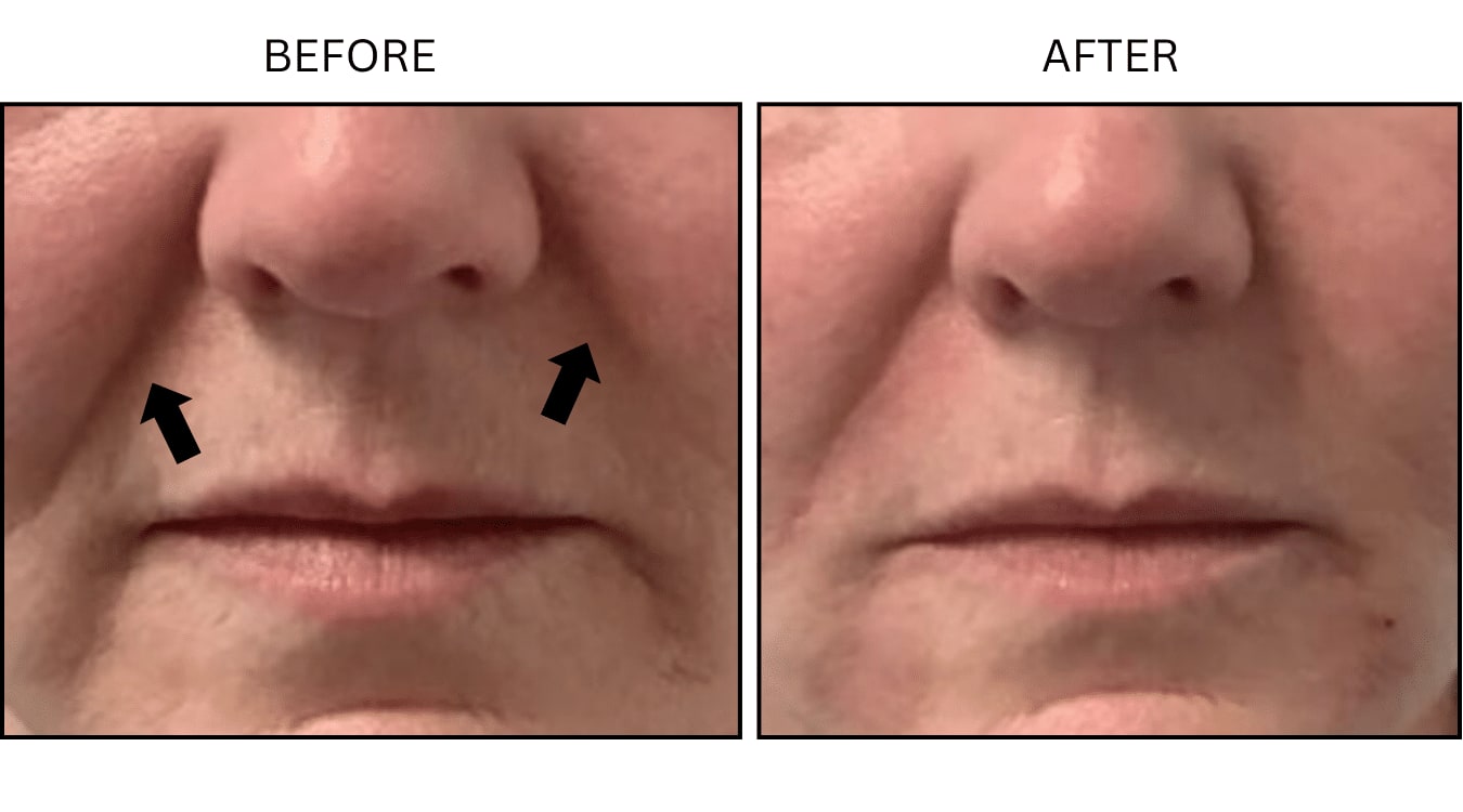 Nasolabial Folds (smile Lines) (Fillers), before and after photograph 1