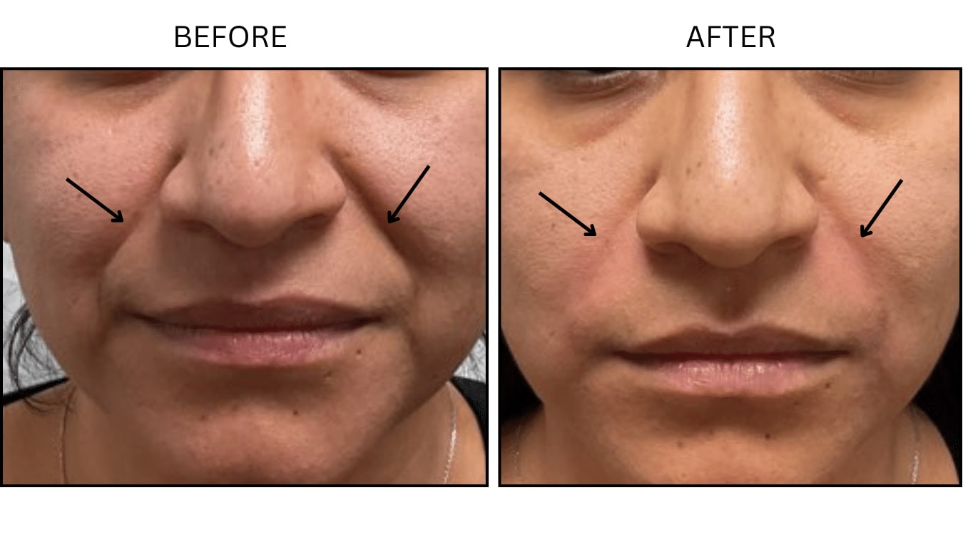 Nasolabial Folds (smile Lines) (Fillers), before and after photograph 8