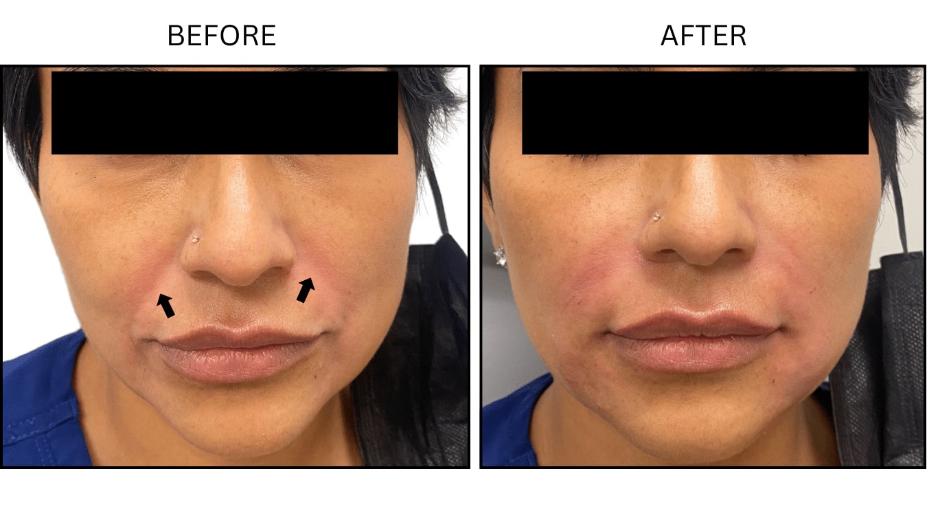 Nasolabial Folds (smile Lines) (Fillers), before and after photograph 5