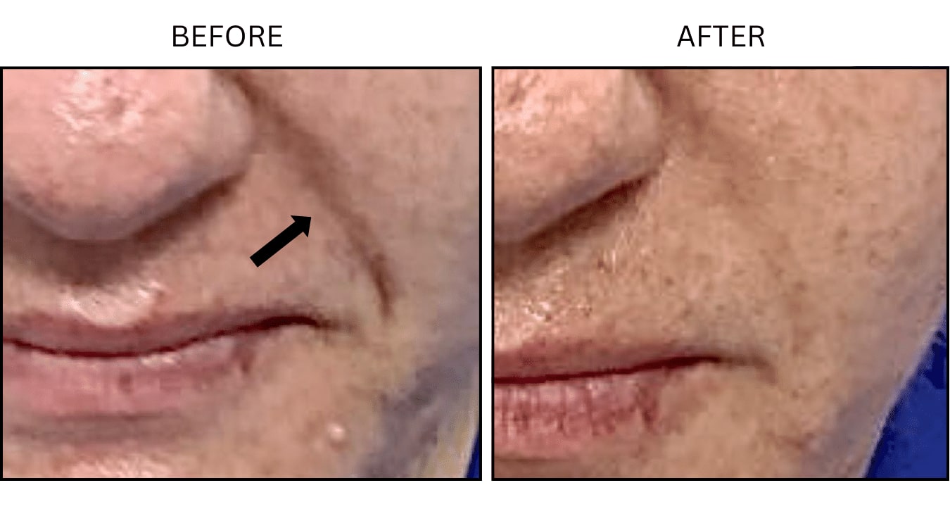 Nasolabial Folds (smile Lines) (Fillers), before and after photograph 3