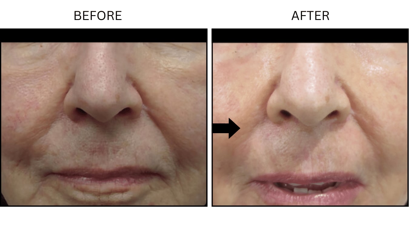 Nasolabial Folds (smile Lines) (Fillers), before and after photograph 4