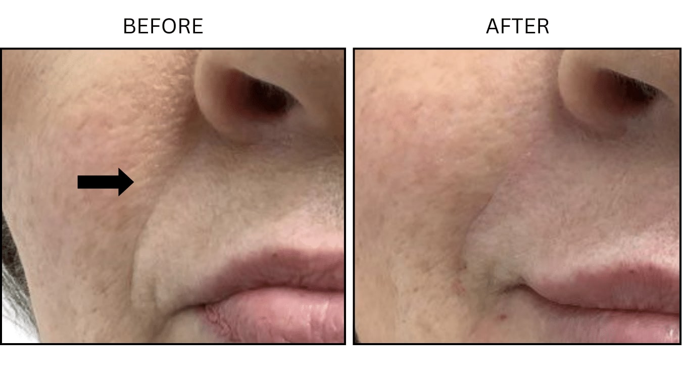 Nasolabial Folds (smile Lines) (Fillers), before and after photograph 2