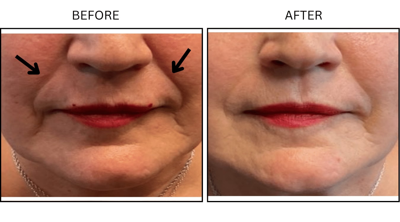 Nasolabial Folds (smile Lines) (Fillers), before and after photograph 6