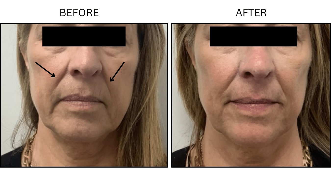 Nasolabial Folds (smile Lines) (Fillers), before and after photograph 7