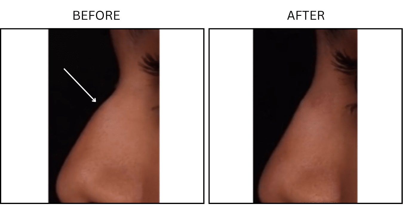Nose (Fillers), before and after photograph 1