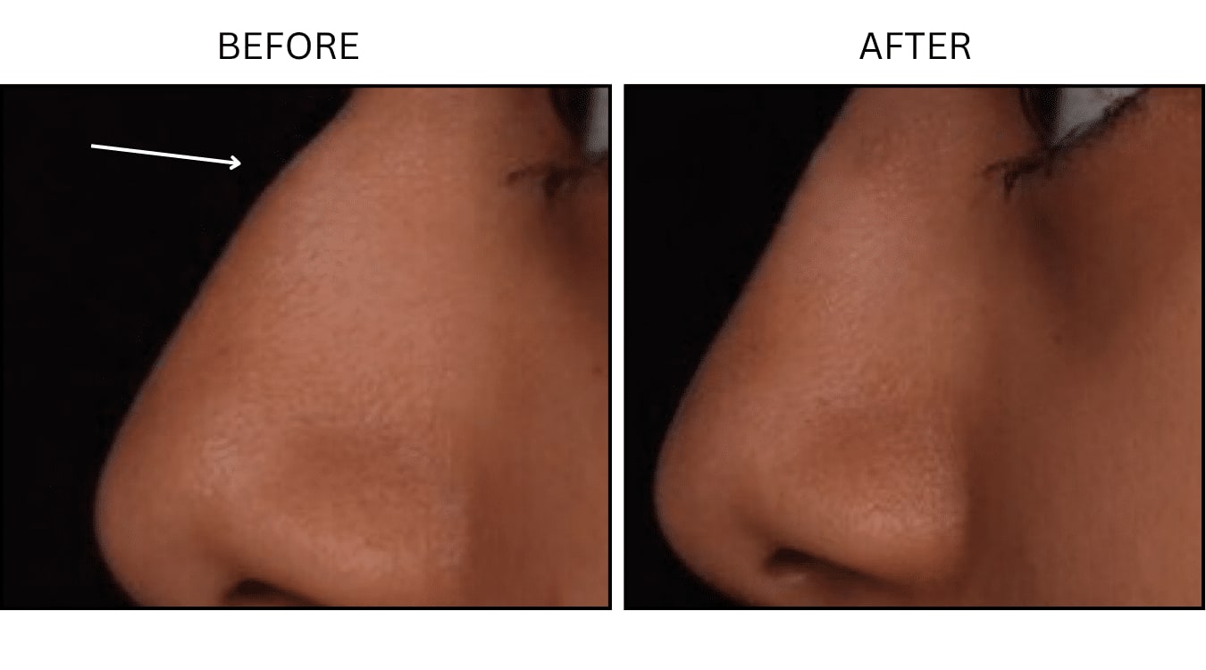 Nose (Fillers), before and after photograph 2