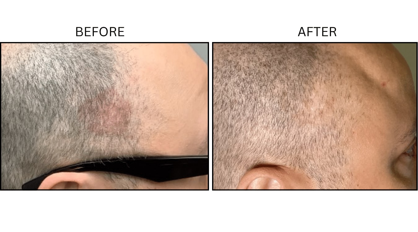 Picosecond (Lasers), before and after photograph 2