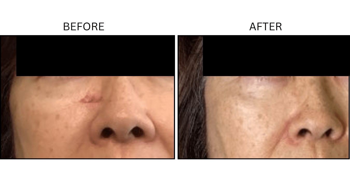 Picosecond (Lasers), before and after photograph 3