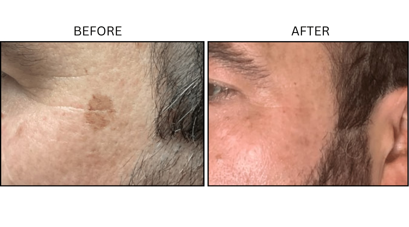 Picosecond (Lasers), before and after photograph 4