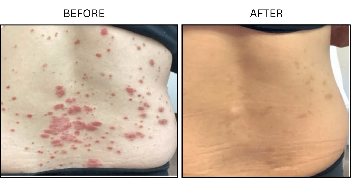 Psoriasis (Medical), before and after photograph 1