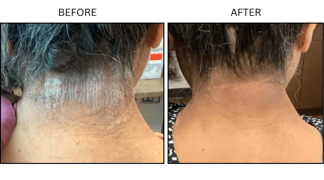 Psoriasis (Medical), before and after photograph 2