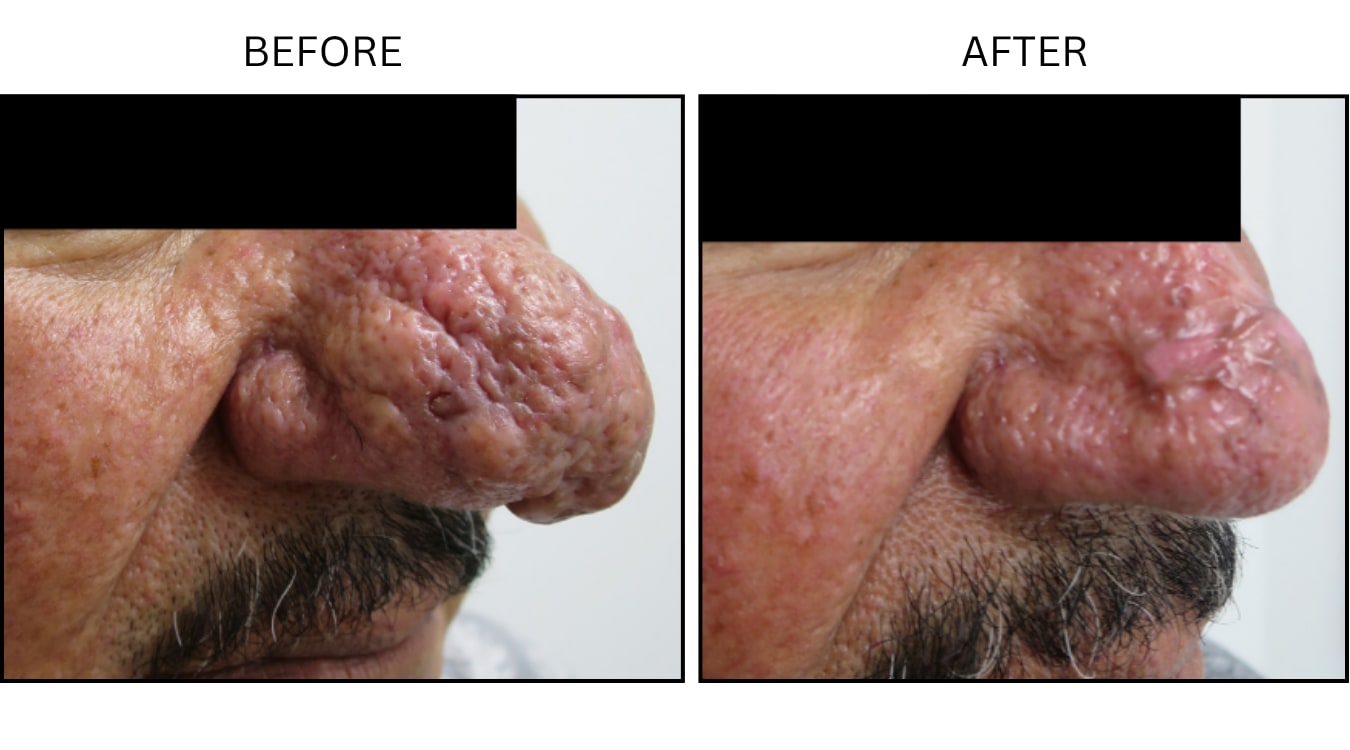 Rhinophyma (Surgical (benign Destruction)), before and after photograph 1