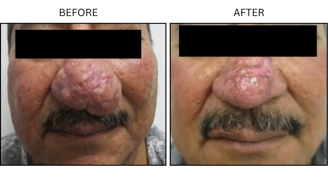 Rhinophyma (Surgical (benign Destruction)), before and after photograph 2