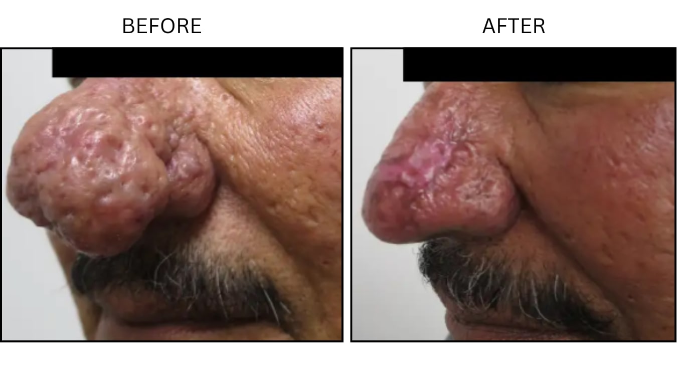Rhinophyma (Surgical (benign Destruction)), before and after photograph 3