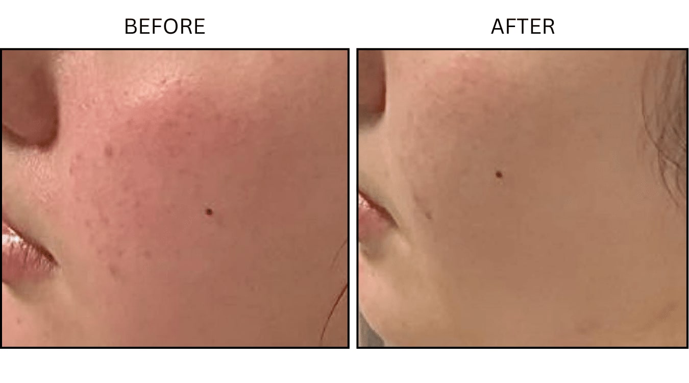 Rosacea (Medical), before and after photograph 1