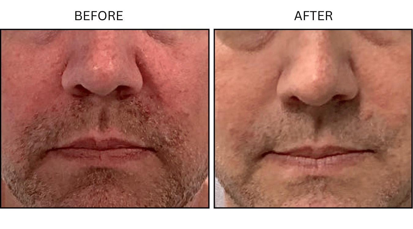 Rosacea (Medical), before and after photograph 4