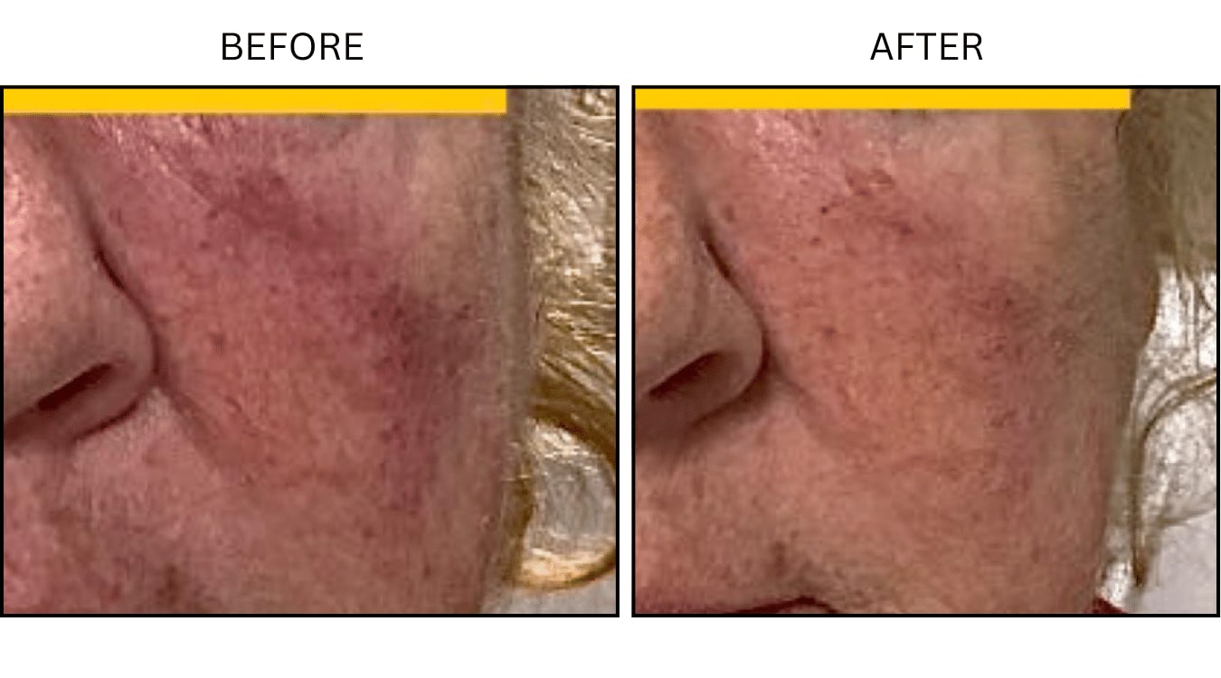 Rosacea (Medical), before and after photograph 2