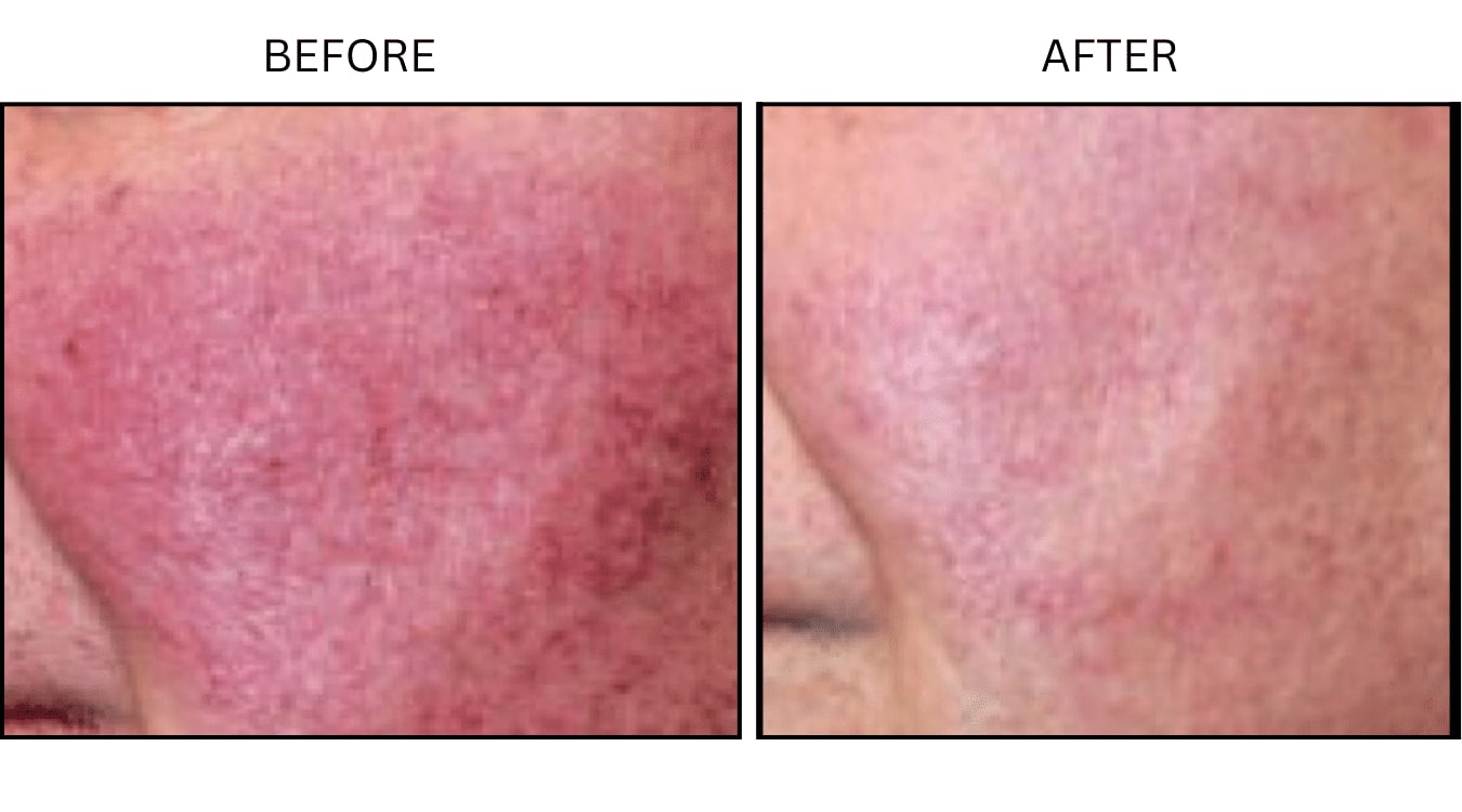 Rosacea (Medical), before and after photograph 3